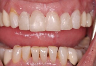 Temporary veneers cemented on the five anteriors after adjustments for establishing the final tooth form.