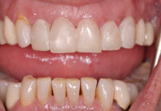 Temporary veneers cemented on the five anteriors after adjustments for establishing the final tooth form.