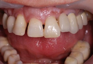 The four upper incisors present with staining, multishading, diastemas, malalignment, poor interrelationship and poor tooth-gingiva ratios.
