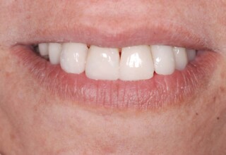 Perfectly aligned teeth on a pleasant patient’s smile.