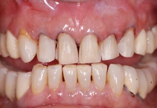 Light preparation of upper anteriors (except of the right canine) for the fabrication of the porcelain veneers.