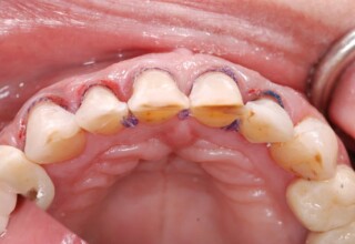 Palatal view of the prepared teeth.