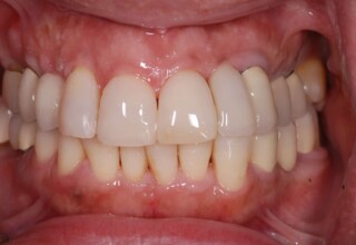 Four intraorally manufactured resin veneers restore the esthetics of the four incisors in an impressive way.