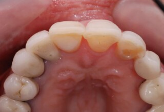 Occlusal view of the restorations. The veneer on the left lateral is on an implant crown.
