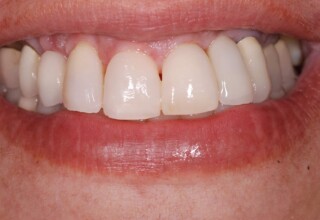 Most of the esthetic concerns of the individual teeth and their relationship with each other and the gingiva were successfully treated.