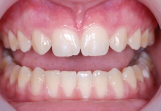 Upper canines orthodonticaly moved forward in the place of
congenitally mssing lateral incisors.