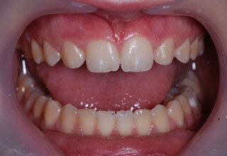 Enameloplasty (<b>slight grinding and polishing</b>) of the canines to remove the “aggressive” sharpness of the incisal edge.