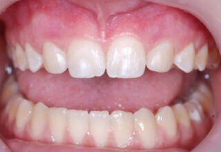 Shape alteration to simulate the missing lateral incisors with the addition of composite resin.