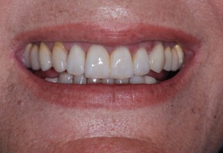 The final cemented veneers. Posterior teeth were also restored. Excellent esthetics and match with the only unprepared anterior tooth the upper right canine.