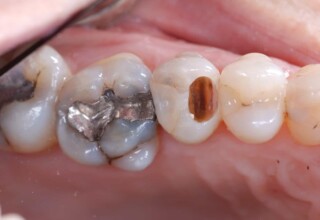 Occlussal view of the stained premolar after the removal of .the old amalgam.