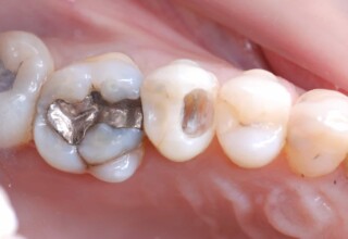 Occlusal view after bleaching.