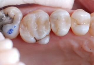 New composite resin restoration on the bleached premolar and on the adjacent molar.