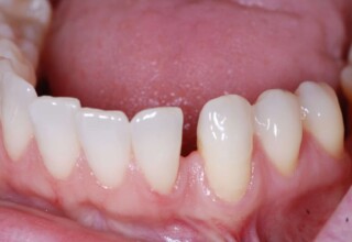 Natural lower diastema between left canine and lateral incisor.