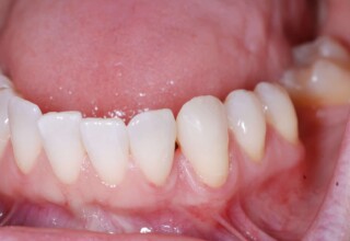 Complete diastema closure with composite resin.