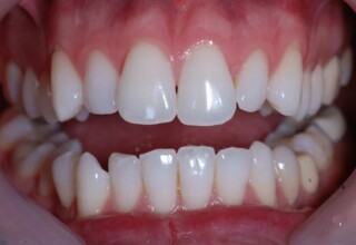 Destaining of the centrals and bleaching of all the teeth.
