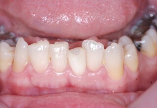 After the bleaching.