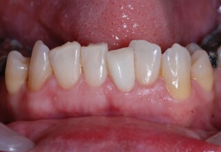 Initial restoration after bleaching.