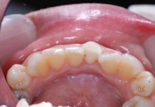 Initial restoration after bleaching.