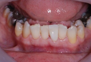 Final restoration of the height with composite resin.