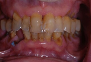 Extensive abrasions in all teeth.