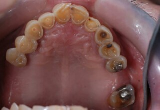 Occlusal view of extensive abrasions of upper teeth