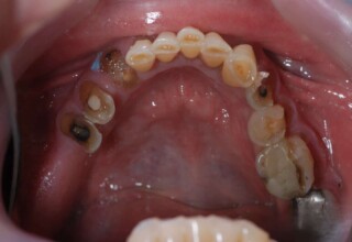 Occlusal view of abrasions, carries and old restorations of lower teeth