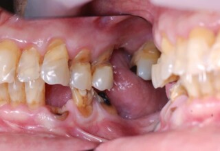 Huge loss of dental tissue with increased fracture risk
