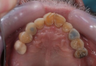 Restorations of upper teeth