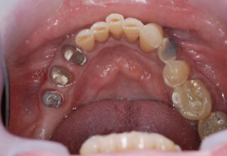 Restorations of lower teeth