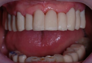 Temporary crowns on upper teeth