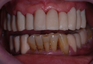 Temporary crowns on lower teeth