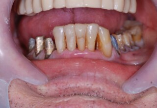 Incisal restorations with composite resin on five lower anterior teeth.