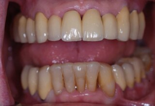Permanent crowns on all teeth except five lower anteriors
