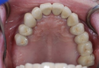 Occlusal view of upper permanent crowns