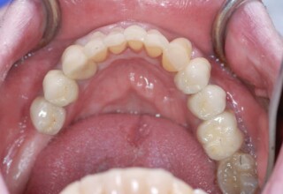 Occlusal view of upper permanent crowns and five lower anterior teeth restorations.