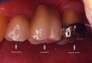 Buccal view of a bridge replacing second upper premolar with anterior abutment the first premolar and posterior abutment the first molar.