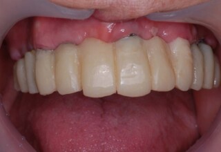 Information from the photos was incorporated in the upper temporary implant supported bridge.