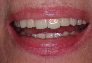 Trials and adjustments of the temporary to achieve optimum esthetics on teeth and facial structures.