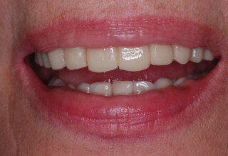 Trials and adjustments of the temporary to achieve optimum esthetics on teeth and facial structures.