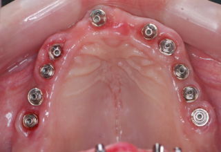Multiple(10) implant placement on the upper jaw, enabled the fabrication of three independent bridges, optimum spread of functional forces, avoiding fatigue of structural parts and avoiding stress concentration