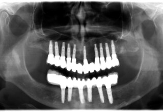 Radiographic appearance of implants, bridges and optimum fit.
