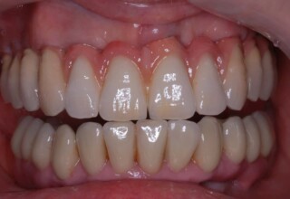 Final upper and lower reconstructions incorporating the information obtained from the last temporary bridge. Elaborate use of pink porcelain allowed minimizing the optical effect of long teeth.