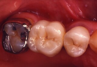 Occlusal view of the same bridge showing the anterior full coverage retainer and the posterior partial coverage retainer.