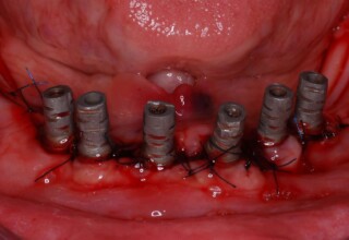 Extraction of lower teeth, direct placement of six implants and preparation for immediate loading.