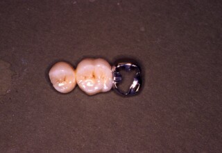 Extraoral view of the bridge that delineates the combination of anterior full coverage and posterior partial coverage.