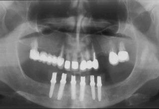 Radiographic appearance of lower six implants
