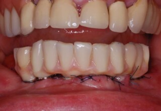 Temporary lower bridge delivered the same day the implants were placed.