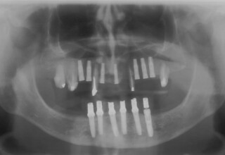 Radiographs showing the upper sequential extractions and implant placement.