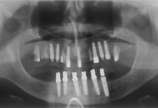 Radiographs showing the upper sequential extractions and implant placement.