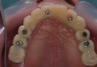 Gradual incorporation of the upper implants in the upper temporary bridge.